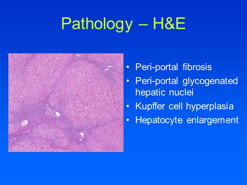 Pathology – H&E Peri-portal fibrosis Peri-portal glycogenated hepatic nuclei Kupffer cell hyperplasia Hepatocyte enlargement